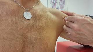 Dry Needling M deltoideus p clavicularis [upl. by Auos9]