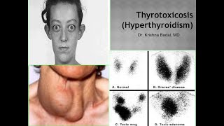 Thyrotoxicosis hyperthyroidism [upl. by Noteloc]