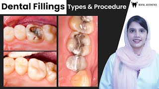 Dental Fillings Types and Procedures Explained  Dental Aesthetics [upl. by Eleda132]