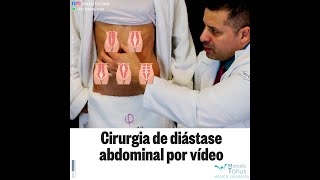 CIRURGIA DE DIÁSTASE POR VÍDEO [upl. by Eceirehs777]