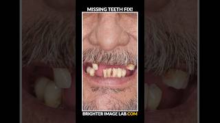 Missing Teeth Solution  Snap On Veneers shorts smiletransformation [upl. by Frendel]