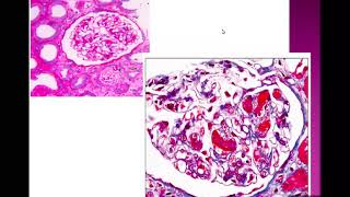 Thrombotic Microangiopathy part 1DrNoha Gamal [upl. by Aicnarf]