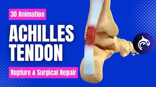 Achilles Tendon Rupture and Repair  3D Animation [upl. by Airamalegna]