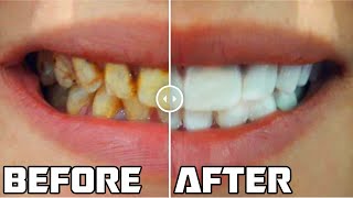 Bright Smile Veneers Worlds Best Veneers amp Clip on Veneers [upl. by Clawson]