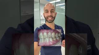 Can Invisalign Fix My Bite 2024 [upl. by Nevaed]