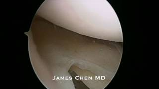 Arthroscopic Saucerization of Discoid Meniscus [upl. by Anawik230]