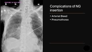 NG tube complications [upl. by Ringler]