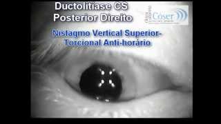 VPPB  quotLabirintitequotVideonistagmoscopiaDuctolitiase do Canal Semicircular Posterior DireitoBPPV [upl. by Hamfurd]