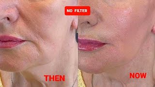 AMAZING LIFTING Massage  Sagging jowls  Nasolabial folds  Marionette lines  Double chin [upl. by Ynabla766]