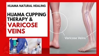 Varicose Veins treatment hijama therapy [upl. by Einuj]