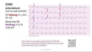 Herz 11 EKG 4  STEMI Perikarditis Extrasystole Kammerflimmern [upl. by Eihpos]