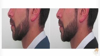 Eliminar Cicatrices en Cejas Cabeza Bigote Y barba con Implantes Capilares  Tratamiento [upl. by Anwahsit]