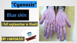 CyanosisBlue SkinFreeMedicalEducationld3sfCyanosismedicalnursingmbbsviralmedicalvideos [upl. by Clementine693]