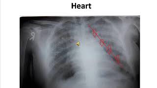 Mitralization of Heart  Chest Xray of Mitral Stenois [upl. by Eidnas]