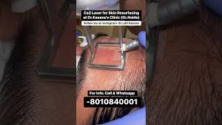 co2 laser treatment for acne scars  DrLalit Kasanas [upl. by Anidal]