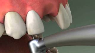 Dentist  Maryland Bridge Procedure [upl. by Lethia]