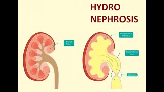 Surgery 945 Hydronephrosis Case Viva Questions Clinics History Differential Dietl Anderson Hynes [upl. by Jules935]