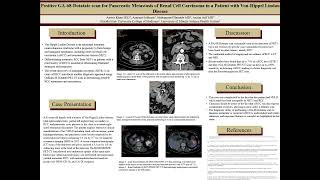 Positive GA68Dotatate PETCT scan for Pancreatic Metastasis of Renal Cell Carcinoma [upl. by Ellerrehc15]