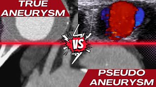 True Aneurysm vs Pseudoaneurysm [upl. by Auqinom]