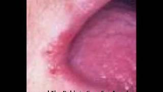 Cracked Corners of Mouth  Symptoms Treatment and Natural Home Remedies [upl. by Latoyia616]