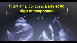 Cardiac tamponade echocardiography findings SafaMedicalLecture [upl. by Edna931]