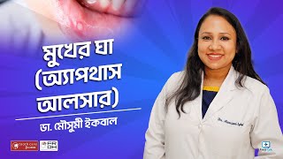 মুখের ঘা অ্যাপথাস আলসার Aphthous ulcer treatment bangla [upl. by Siravrat208]