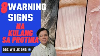 8 Warning Signs ng Kulang sa Protina  by Doc Willie Ong [upl. by Ahsielat319]