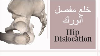 خلع مفصل الورك  Hip joint dislocation [upl. by Nyloc]