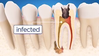 Root Canal Treatment Step by Step [upl. by Lucius]