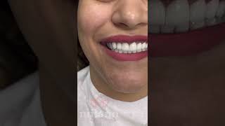 Emax Laminate Veneers in Turkey [upl. by Eiznil]