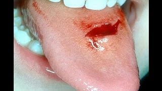 management of tongue lacerations [upl. by Enilarac311]