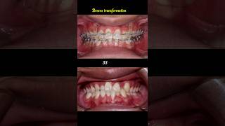 Cross bite braces transformation braces orthodontist dentist [upl. by Aehsila]