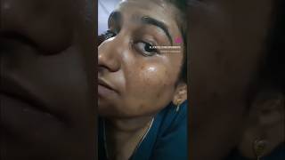 Best Serum for pigmentation in india for oily skin skinbrightening brighteningserum beauty [upl. by Garibull304]