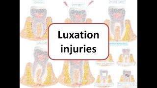 Luxation Injuries Concussion Subluxation Extrusive Lateral amp intrusive luxation [upl. by Norvun76]