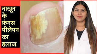 How to cure nail fungus  नाखून का फ़ंगस इन्फ़ेक्शन  Onycomycosis Treatment in Hindi [upl. by Solomon80]