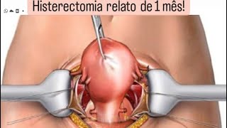 Relato histerectomia total 1 mês após a cirurgia [upl. by Anivel]