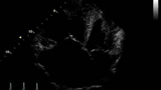 ACUTE PULMONARY HEART DISEASE  THROMBUS PULMONARY ARTERY [upl. by Nadruoj]