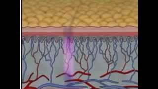 Phases of Wound Healing Pt 2  Wound Care Management  WoundEducatorscom [upl. by Ariad]