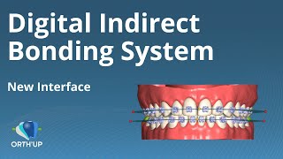 Digital Indirect Bonding System  ORTHUP [upl. by Skyla]