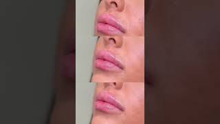 Juvederm Ultra Lip Filler 👄💉 Before and After [upl. by Atinauj139]