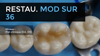 105  Restauration MOD en résine composite sur molaire mandibulaire [upl. by Anirtal]