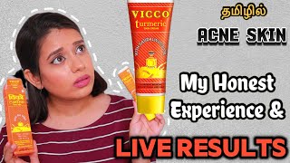 I TRIED VICCO CREAM FOR A WEEK ON ACNE SKIN AND THIS HAPPENED  Vicco Turmeric cream Review in Tamil [upl. by Guerin]