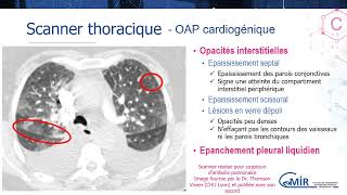 3 15 4 œdème aigu pulmonaire cardiogénique  Scanner [upl. by Arodal]