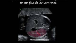 Infeccion Intrauterinawmv [upl. by Cinimmod]