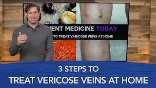 3 Steps to Treat Varicose Veins at Home [upl. by Cathy949]