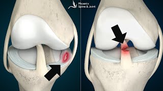 Is your knee pain coming from an ACL tear or Meniscus injury How to tell [upl. by Geer]