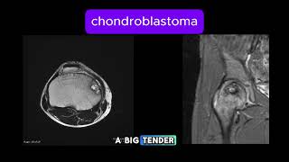 Chondroblastoma [upl. by Bealle988]