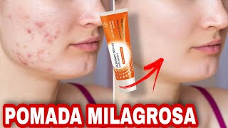 POMADA QUE ACABA COM A ACNE MELASMA MANCHA NO ROSTO ROSÁCEA E MAIS AZELAN [upl. by Zsa Zsa447]