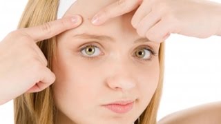 How to Get Rid of Forehead Acne Acne Scars Treatment Removal Medication Cure Home Remedies [upl. by Ephram13]