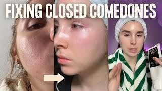 CLOSED COMEDONES  How I cleared my clogged pores routine and products [upl. by Swee968]